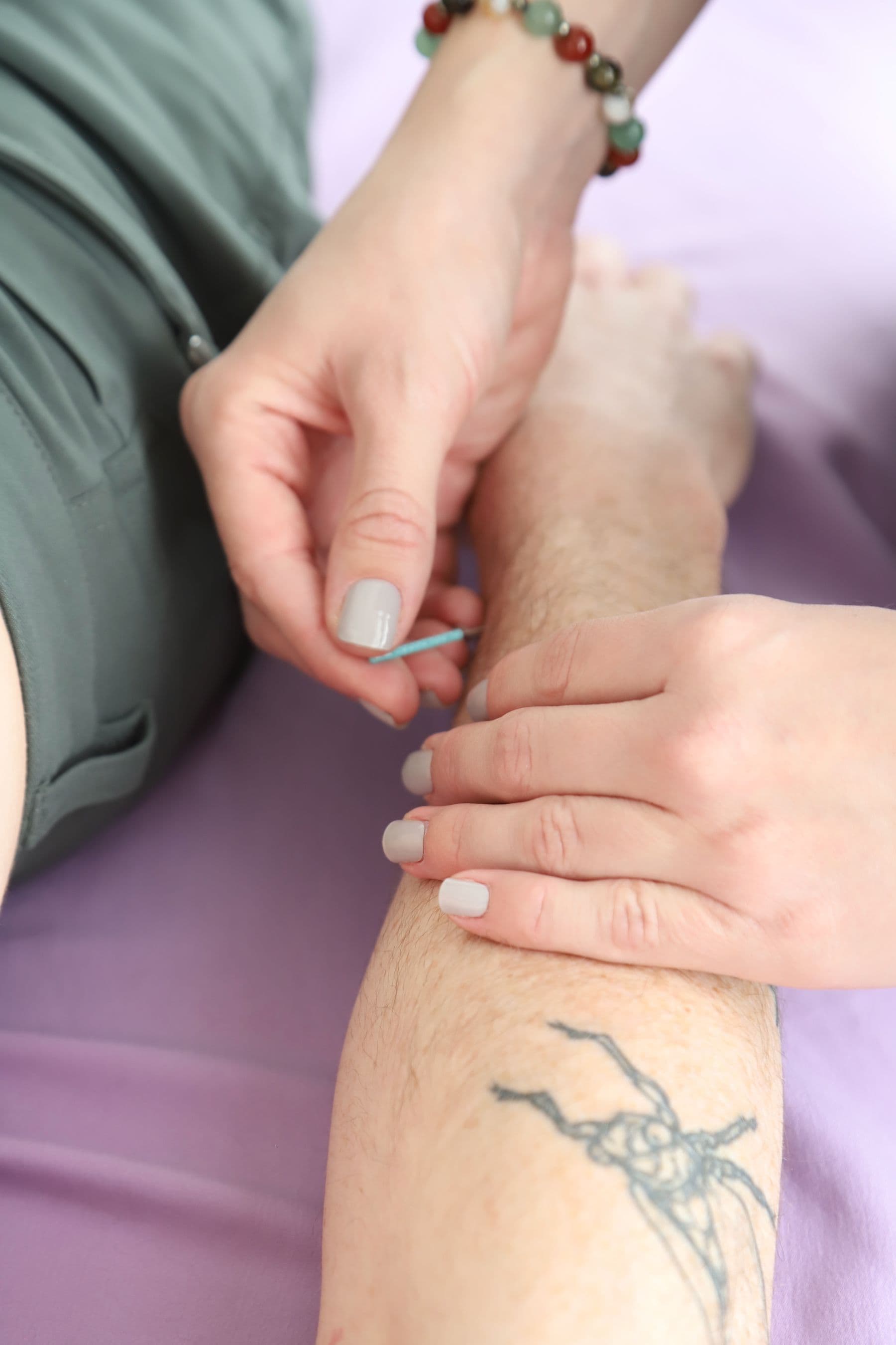 Acupuncture